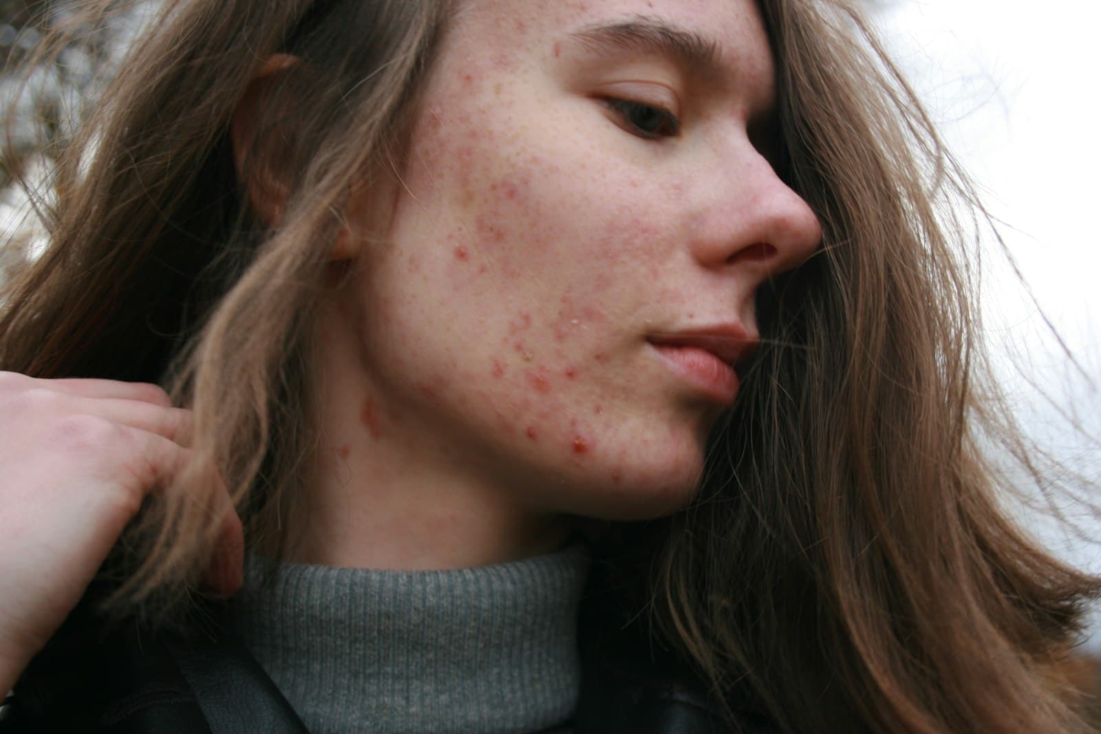 Woman with red, irritated patches and small breakouts across her cheek