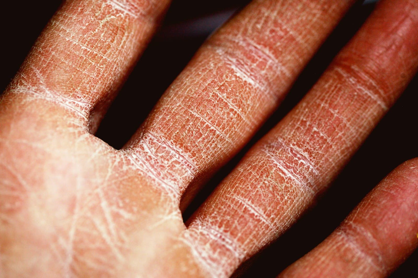 Close-up of very dry, cracked and flaky skin on the fingers